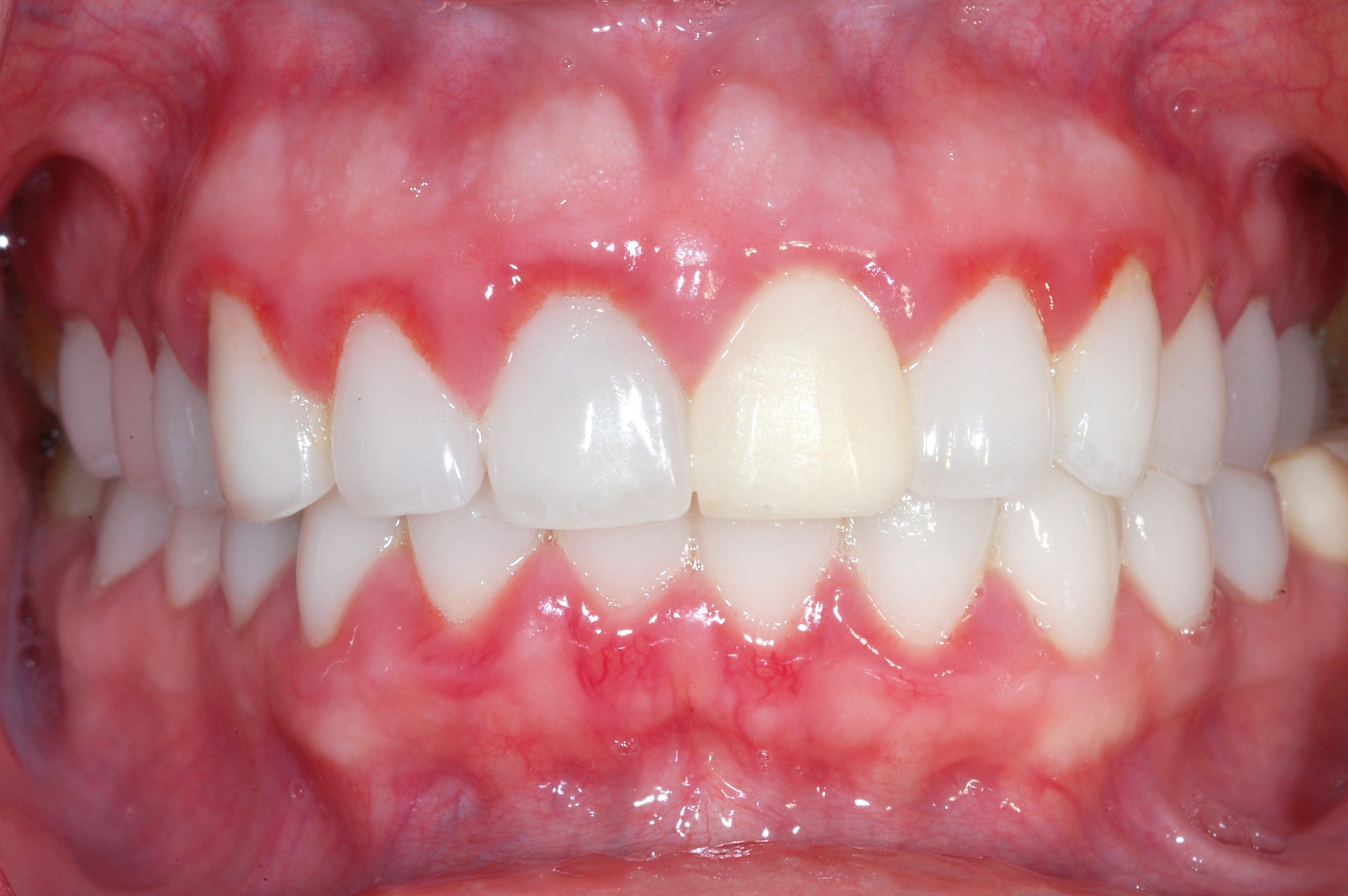 Lợi dễ bị tụt xuống , răng bị lung lay và nếu diễn tiến nặng thì có thể bị rụng răng