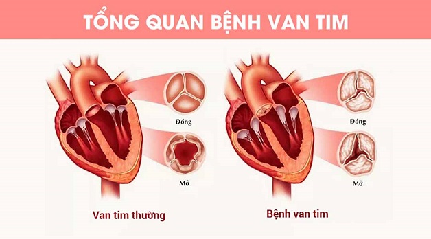 Hở và hẹp van tim: Nhận biết và điều trị thế nào? | TCI Hospital
