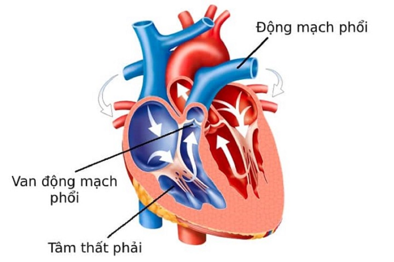 Tăng áp động mạch phổi có thể gây ra nhiều biến chứng ở tim