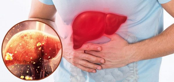 Lượng men gan cao ở người uống rượu, bia tùy thuộc vào liều lượng và chất lượng của rượu, bia.