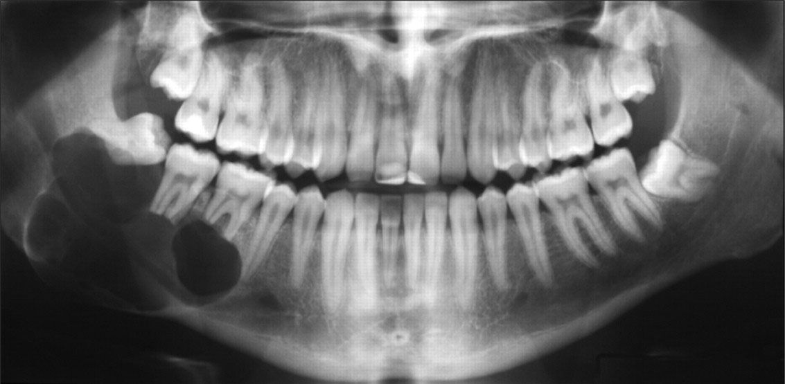 Hình ảnh chụp XQuang hàm có nang răng