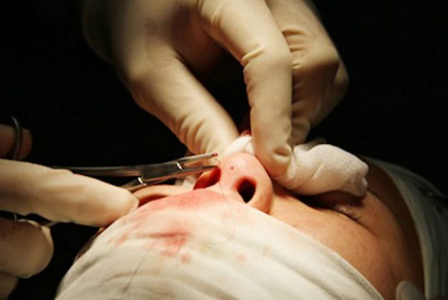 Khám phá quy trình phẫu thuật vẹo vách ngăn mũi