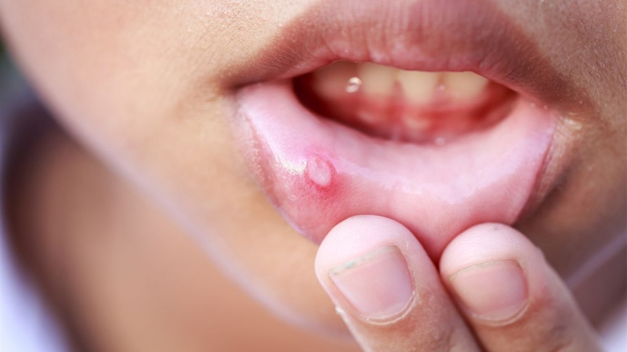 Nguyên nhân lở miệng là thiếu vitamin gì?