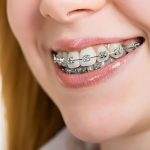 “Giải mã” tại sao niềng răng bị hóp má và cách khắc phục 