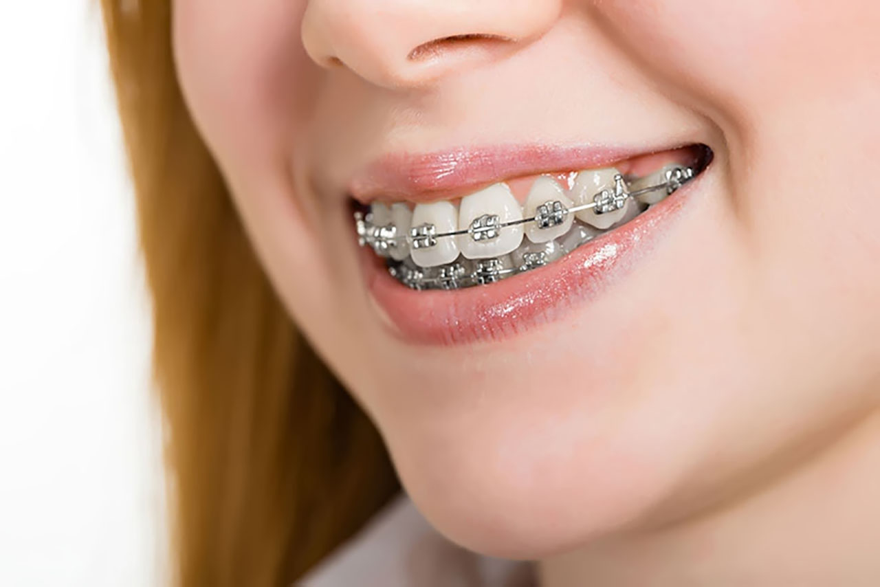 Bài tập cơ miệng có tác dụng gì trong việc khắc phục tình trạng hóp má khi niềng răng?
