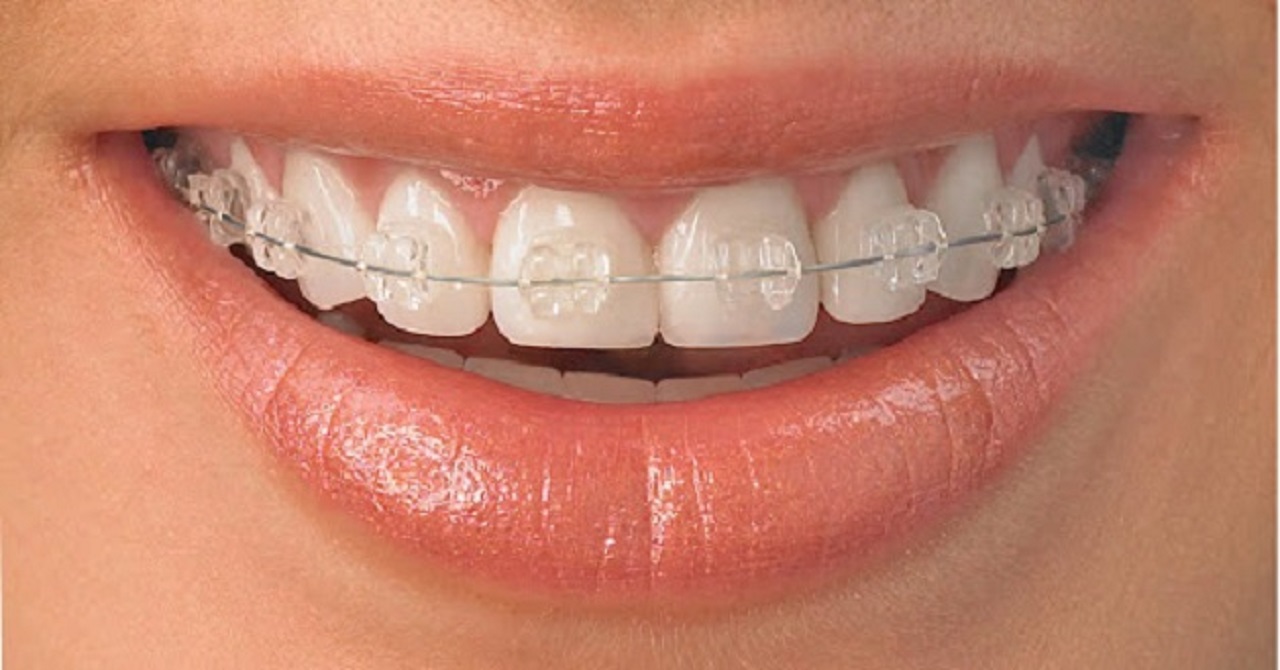 Niềng răng pha lê có thể mang lại kết quả như thế nào trong việc khắc phục tình trạng răng lệch?