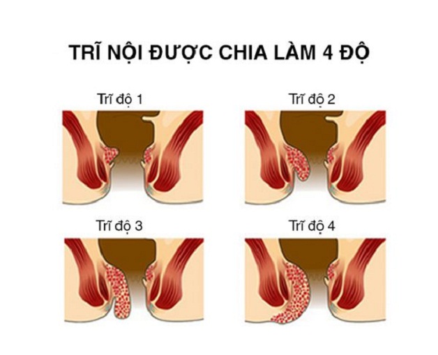 Phẫu thuật cắt trĩ giá bao nhiêu phụ thuộc vào mức độ của búi trĩ