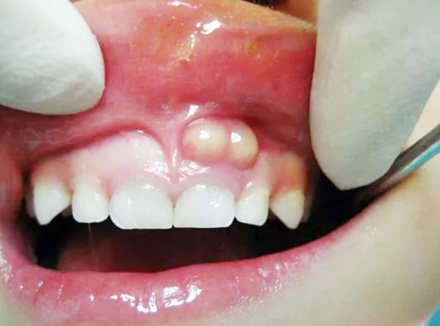 Nang răng là một loại nang biểu mô của xương hàm liên quan đến hiện tượng nhiễm trùng chân răng
