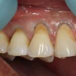 Phục hồi cổ răng bằng Composite – có phải ai cũng có thể thực hiện?