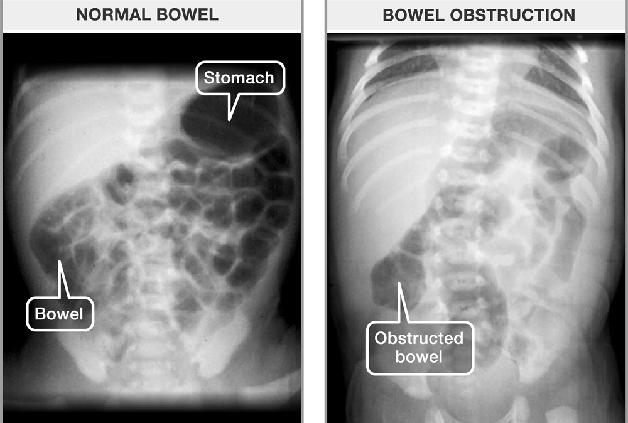 Hình ảnh X Quang trong tắc ruột ở trẻ sơ sinh
