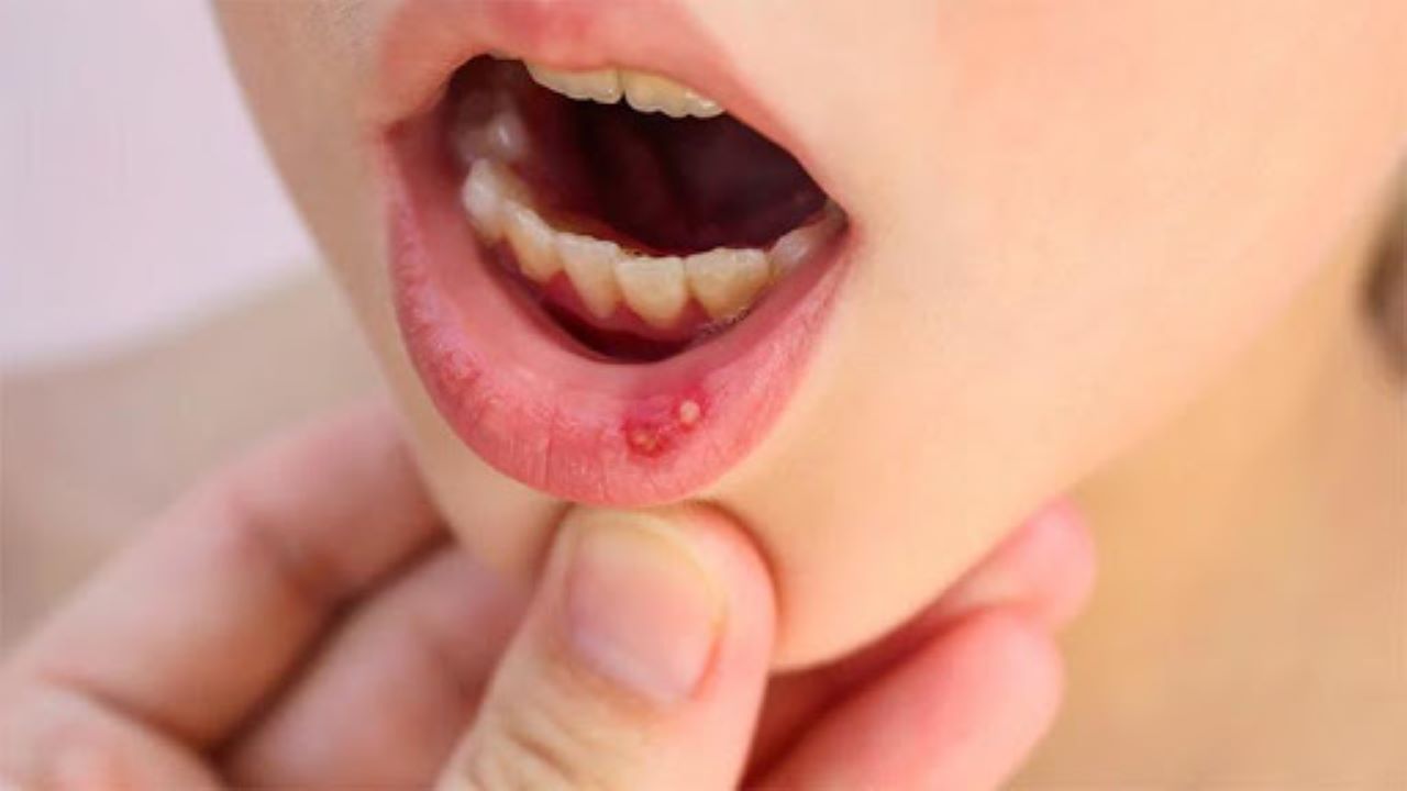 Nhiệt miệng xuất hiện những triệu chứng gì?
