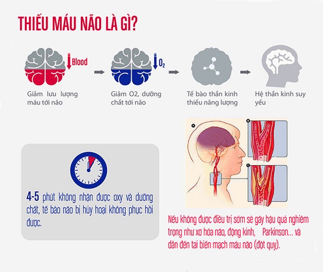 Thiếu máu não điều trị bao lâu?