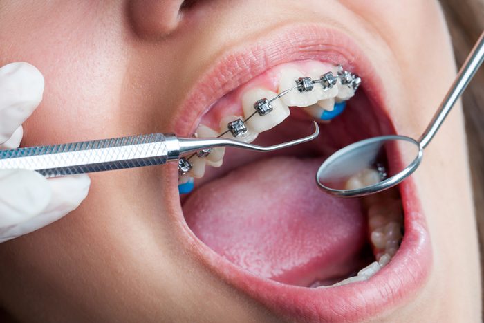 Niềng răng mắc cài cho hiệu quả tốt hơn nhiều phương pháp khác song tính thẩm mỹ không cao