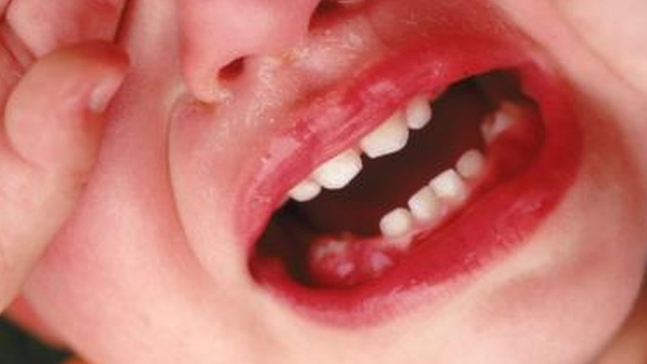 Bệnh viêm nướu răng có mủ ở trẻ được gây ra bởi nguyên nhân nào?