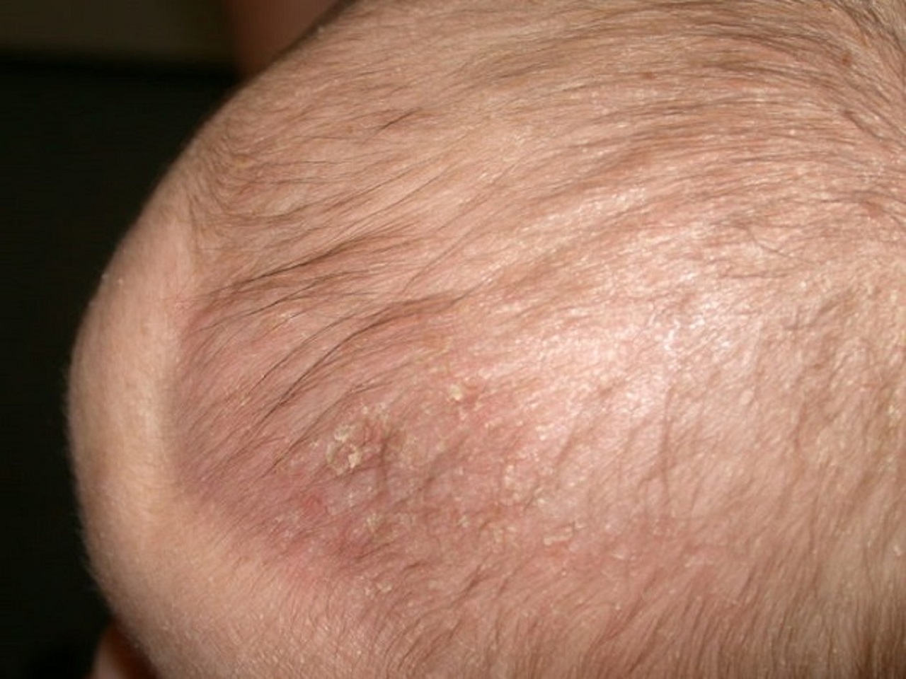 Mụn đỏ trên đầu trẻ sơ sinh có thể lan rộng và làm tổn thương da không?
