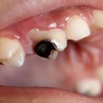 Trẻ bị thối tủy răng gây ra những biến chứng nguy hiểm