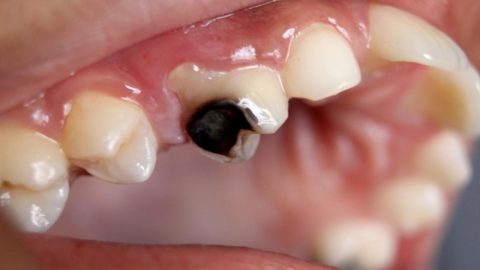 Trẻ bị thối tủy răng gây ra những biến chứng nguy hiểm