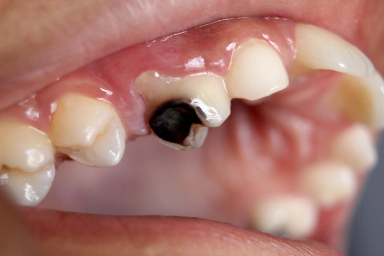 Răng số 8 bị sâu vỡ Nguyên nhân và giải pháp khắc phục  TCI Hospital