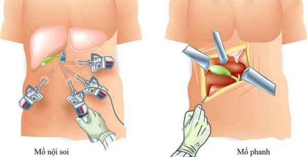 Polyp túi mật là gì? Nguyên nhân và cách điều trị