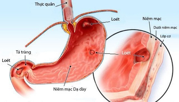 [Giải đáp] Xét nghiệm vi khuẩn Hp dương tính phải làm sao?