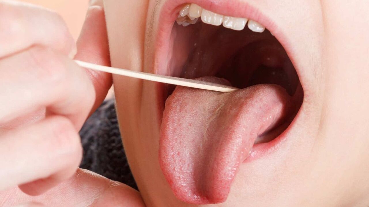 Viêm họng hạt amidan hốc mủ có thể gây biến chứng gì? 
