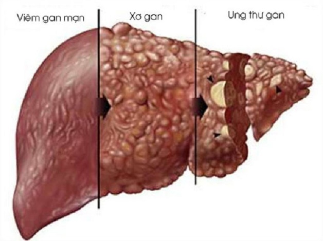 Xơ hóa gan là gì? Các giai đoạn xơ gan | TCI Hospital