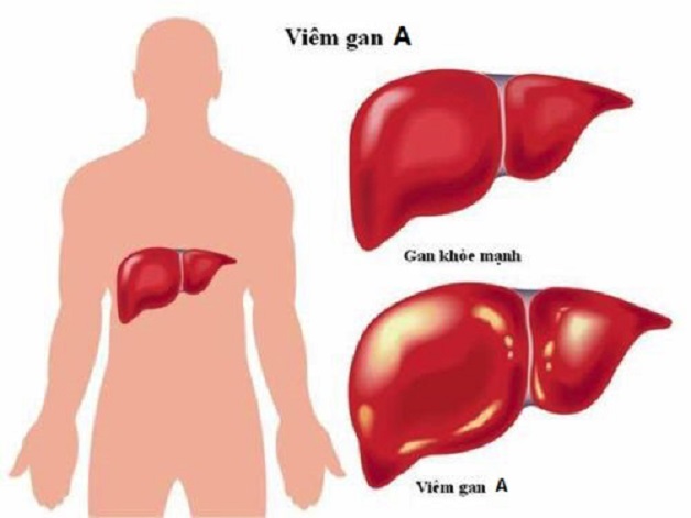 Viêm gan A là bệnh dễ lây nhiễm