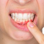 Hình ảnh viêm nướu răng giúp nhận biết dấu hiệu và điều trị hiệu quả