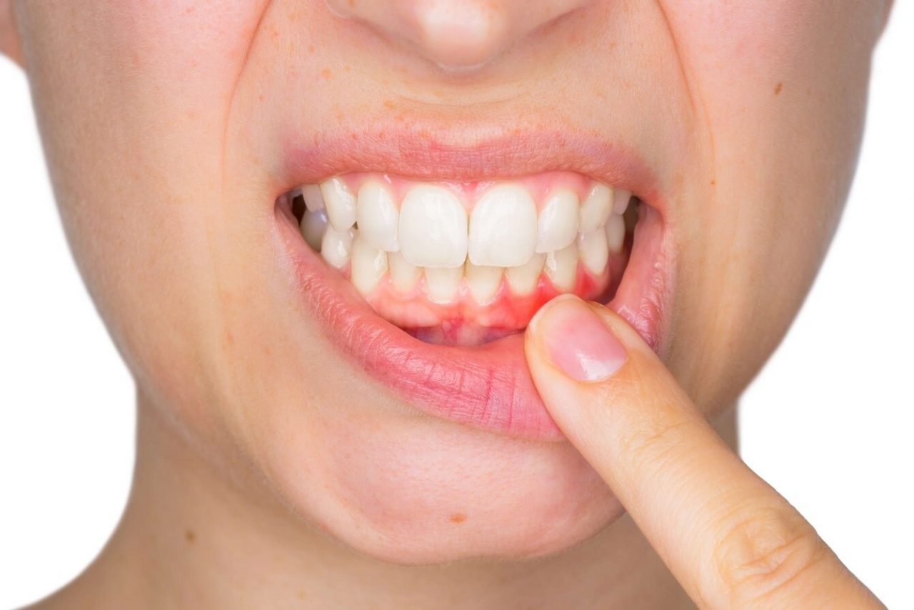 Hình ảnh viêm nướu răng giúp nhận biết dấu hiệu và cách điều trị