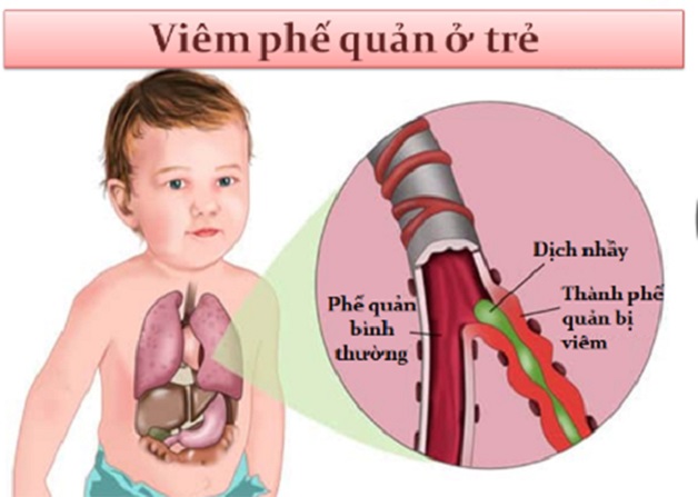 Cách chăm sóc trẻ bị viêm phế quản cấp tại nhà