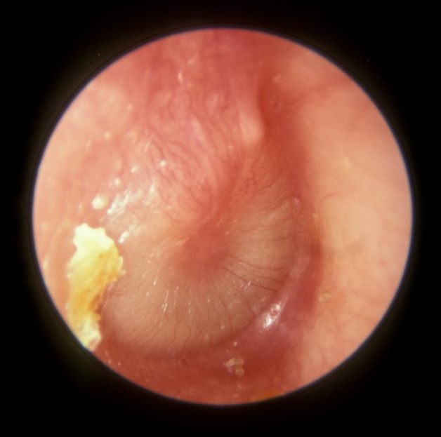 Khi vi khuẩn hay virus xâm nhập vào ống tai sẽ gây nên bệnh viêm tai giữa