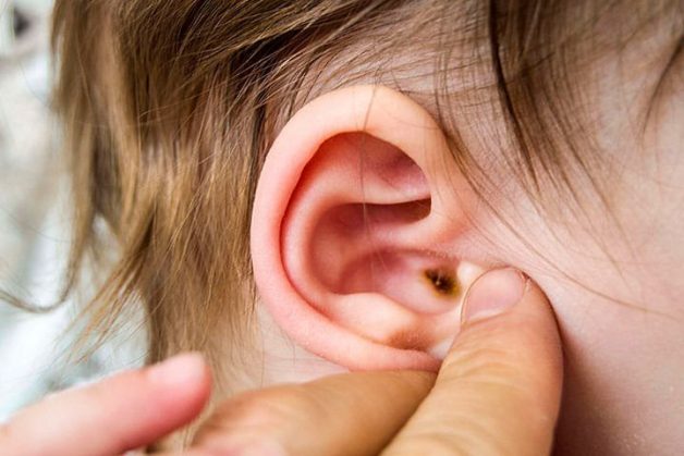 Phòng ngừa và điều trị viêm tai ngoài như thế nào?