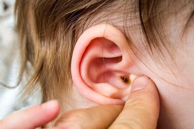 viêm tai ngoài ở trẻ em