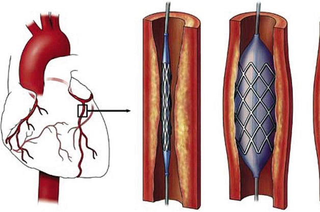 Đặt stent là một trong những phương pháp điều trị bệnh 3 nhánh mạch vành.