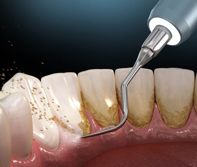 Lấy cao răng bao lâu 1 lần? Bí quyết chăm sóc răng miệng hiệu quả