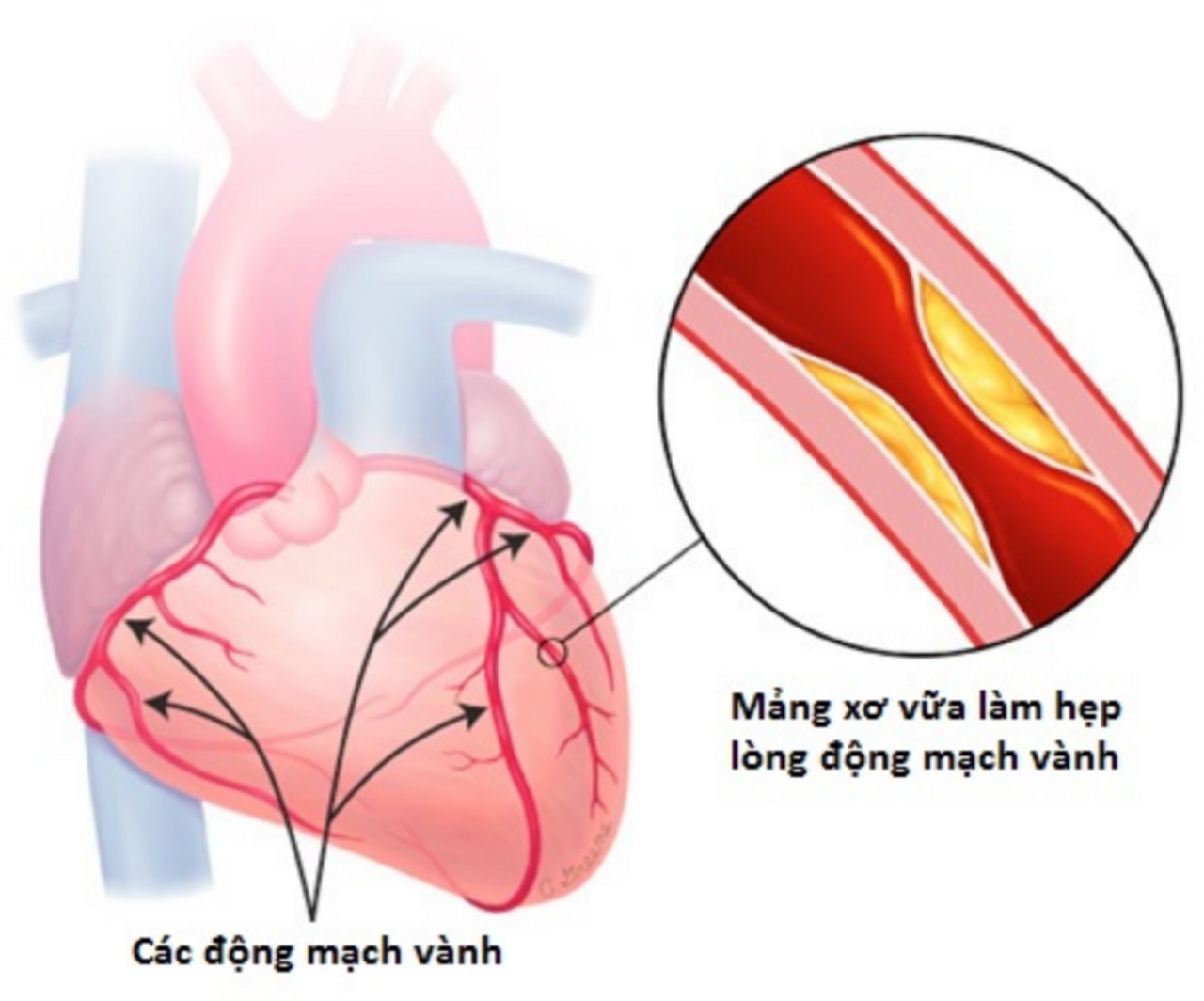 Nguyên nhân gây ra bệnh 3 thân mạch vành là gì?
