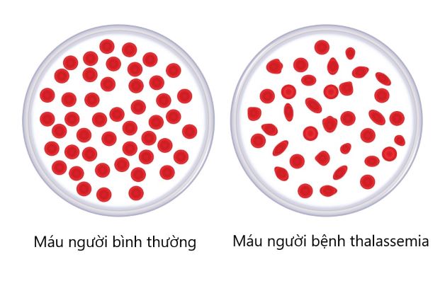 7. Các Nghiên Cứu Mới Nhất Về Thiếu Máu Huyết Tán