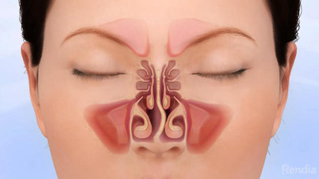 bệnh vẹo vách ngăn mũi và cách điều trị