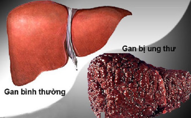 Ung thư gan là biến chứng nặng nề nhất của bệnh viêm gan C