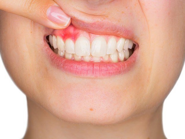Khi bị nhiễm trùng vị trí tiếp xúc giữa răng sứ với nướu thường sưng, tấy đỏ,...