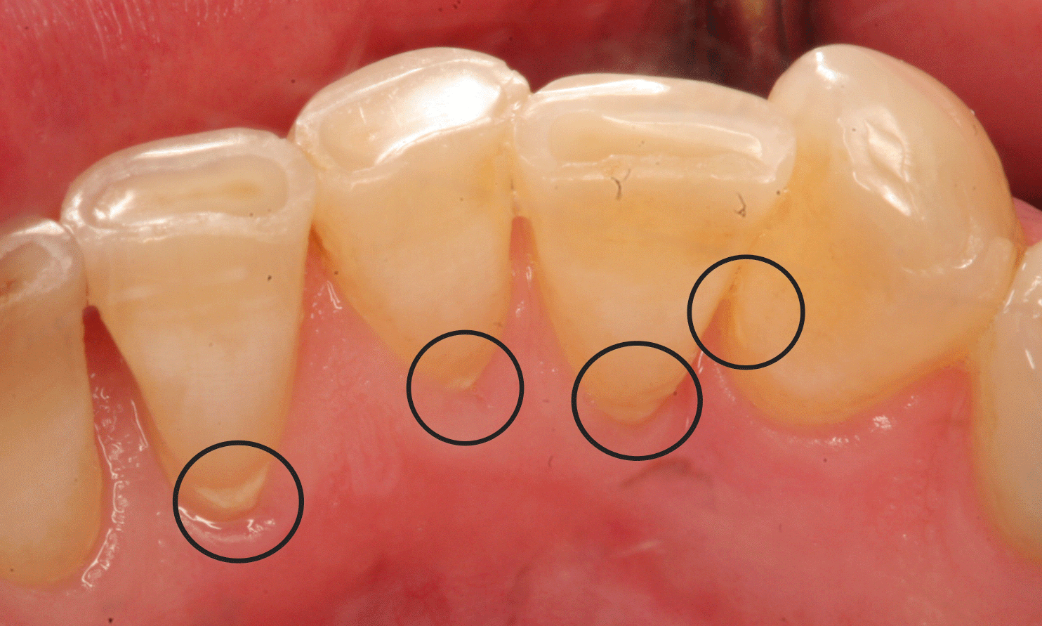 4. Lưu Ý Sau Khi Lấy Vôi Răng