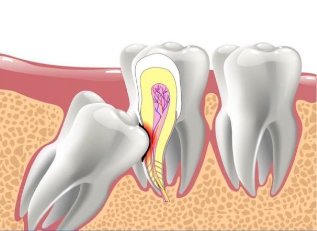 Răng khôn mọc lệch, “chen chúc”, tác động đến răng bên cạnh và làm cho răng bên cạnh bị lung lay, tiêu xương… Lâu dần sẽ khiến cơ xương hàm bị lệch lạc, mất cân đối.