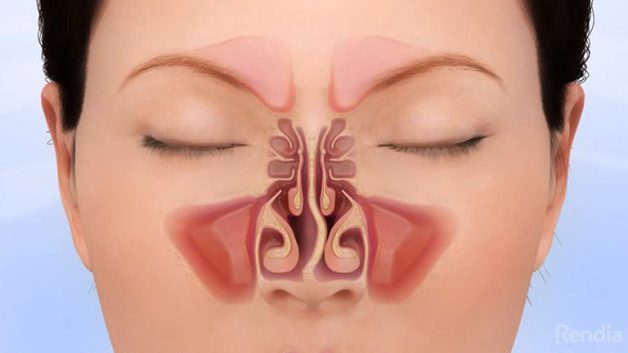 Bệnh vẹo vách ngăn mũi như thế nào và do đâu?