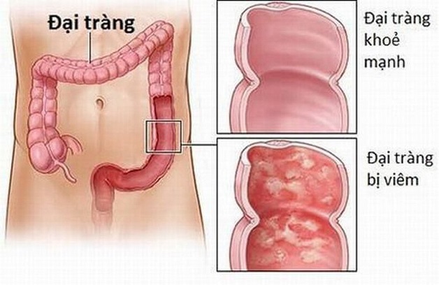 Các cơn đau bụng trong viêm đại tràng thường xuất hiện ở vùng dưới rốn.