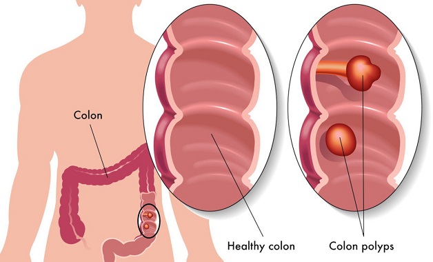 Khi polyp đại tràng có kích thước lớn gây cản trở đường tiêu hoá sẽ dẫn đến đau bụng, buồn nôn, rối loạn tiêu hoá