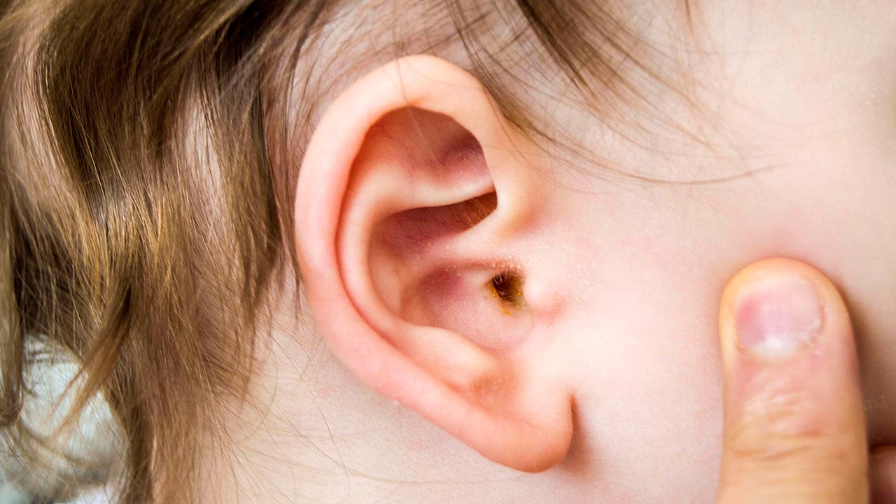 Hành động ngoáy tai bằng tăm bông có thể gây chảy máu không?
