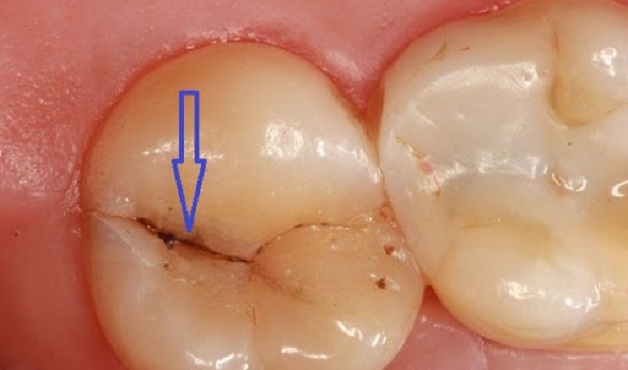 Mẹo chăm sóc và phòng ngừa đau răng số 7