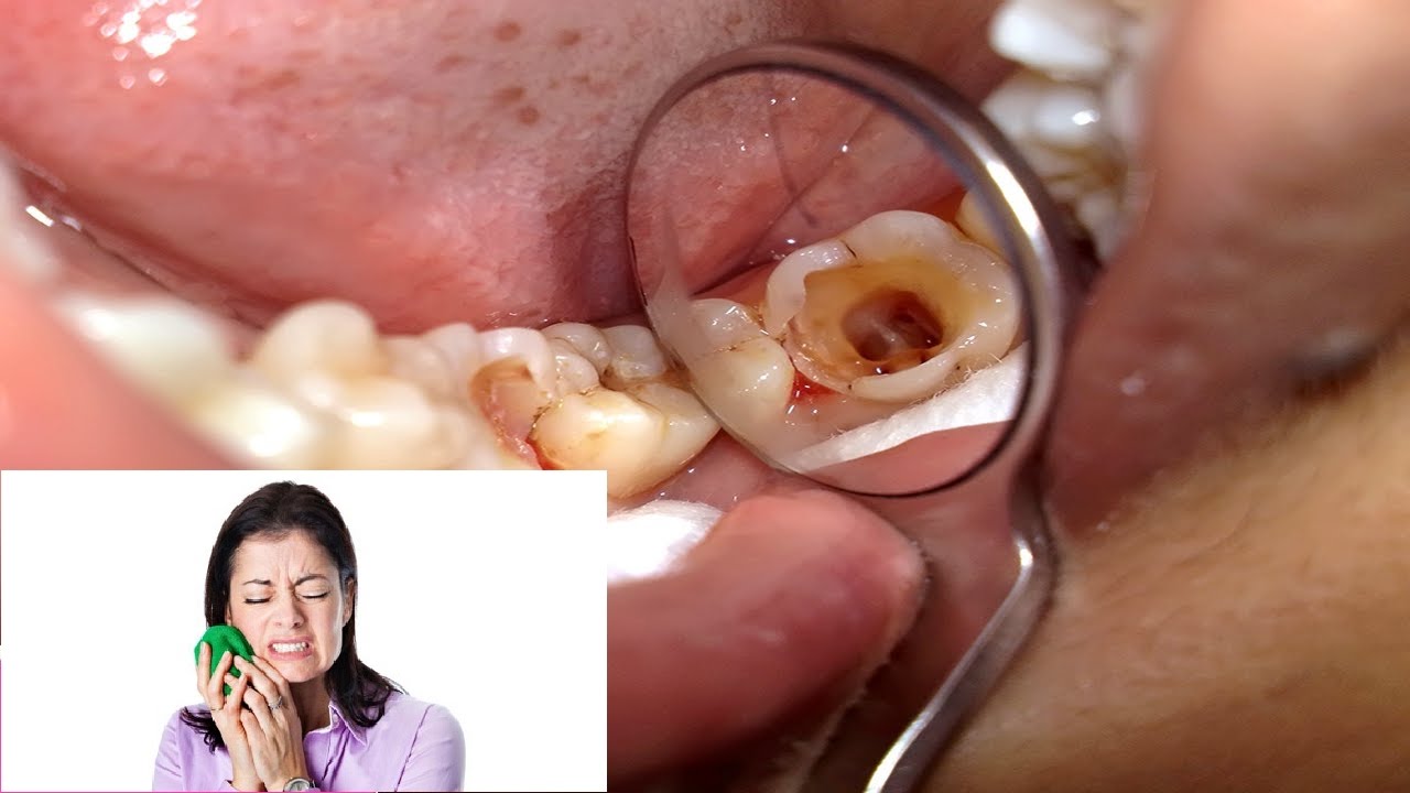 Cách giảm đau và chữa trị viêm tủy răng cách giảm đau viêm tủy răng hiệu quả