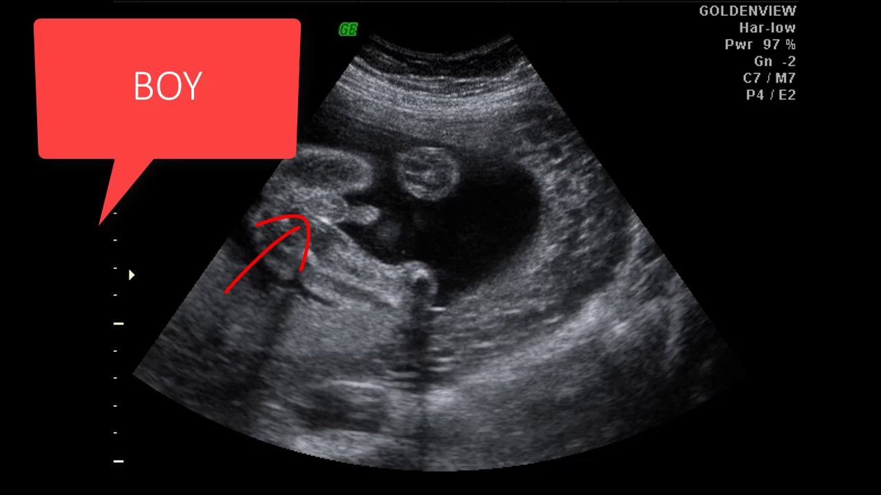 Узи ребенка на 13 неделе. Фото УЗИ определение пола. УЗИ 12 недель беременности фото.