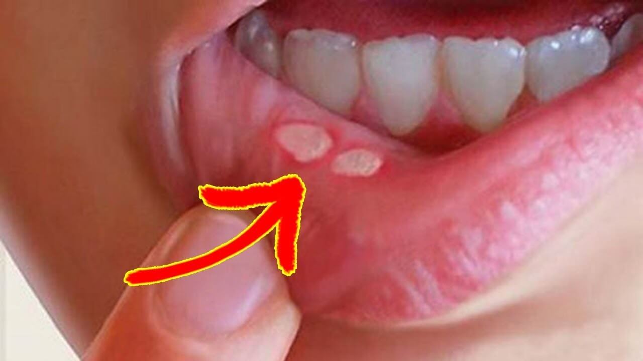 Điều gì cần lưu ý khi sử dụng thuốc bôi nhiệt miệng cho trẻ nhỏ?
